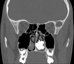 4 describe the arterial supply of nasal septum. An Unusual Case Of Chronic Nasal Foreign Body Bmj Case Reports