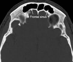 Image result for Sinus CT