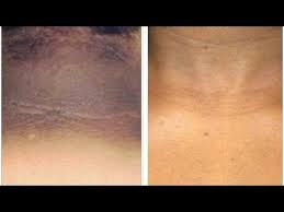 How To Get Rid Of Dark Neck Fast And Easy Natural Remedy Brown Skin Around Neck Youtub Dark Skin Around Neck Dark Neck Remedies Beauty Tips For Glowing Skin