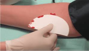 Image result for Bleeding Time