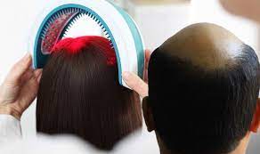 A study from egypt on female hair loss sufferers found that combination lllt+minoxidil 5% treatment led to the better outcomes (measured via ludwig scale classification and patient satisfaction) in comparison to. Hair Loss Treatment Alopecia May Be Treated With Low Level Laser Therapy Express Co Uk