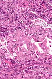 May 31, 2018 · the transformation zone of the cervix is the region where squamous epithelium replaces glandular epithelium in a process called squamous metaplasia. Squamous Metaplasia Wikipedia