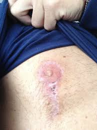 Image result for Purse String Suture