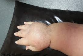 Basit Sislikler Lenfodem Habercisi Olabilir Saglik Haberleri