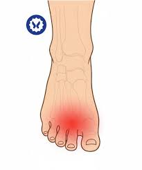 Image result for Metatarsalgia