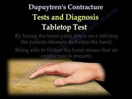 Dupuytren S Contracture Everything You Need To Know Dr Nabil Ebraheim Dupuytren S Contracture Hand Therapy Arthritis Relief