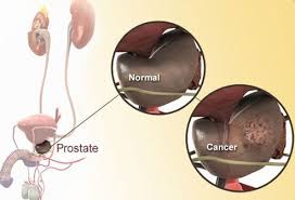 prostate specific antigen psa test results levels ranges