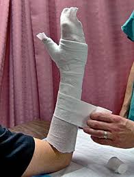 Image result for Short Arm Cast