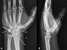 Image result for Lunate Dislocation