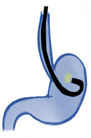 Hiatushernie Hill Klassifikation Antireflux Info