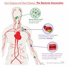 The Surprising Link Between Periodontal Disease And Heart Health What Dental Professionals Need To Know Gumcare G In 2020 Periodontal Disease Periodontitis Gum Care