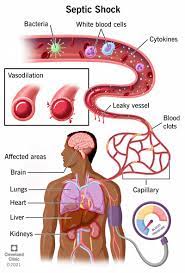 Septic Shock: Causes, Symptoms & Treatment