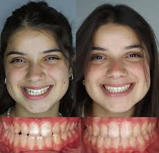 مرح كانت تعاني من عضة عكسية مع ميلان في الفك السفلي وتضيق بالفك العلوي  وميلان واضح بخط المنتصف. تم بفضل الله علاج الحالة بالتقويم الثابت وتوسيع  الفك العلوي وإستخدام المطاطات لتحسين علاقة