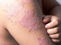 Image result for Atopic eczema atopic dermatitis
