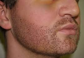 All you need is a boost in vitamins to start regrowing hair. How To Deal With Bald Spots In Beard Hair Transplant In Dubai Cost