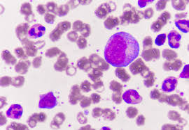 Los factores de riesgo de su aparición son muy variados e incluyen aspectos genéticos y adquiridos. Leucemia Mieloide Aguda Con Minima Diferenciacion Lma M0