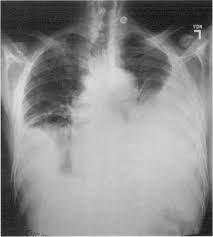 Image result for Pleural Tuberculosis