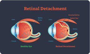 Image result for Retinal Detachment