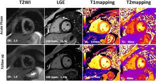 Cardiac magnetic resonance imaging (mri) can be useful for the diagnosis of cardiac involvement. Application Of Multiparametric Quantitative Cardiac Magnetic Resonance For Detection And Monitoring Of Myocardial Injury In Patients With Fulminant Myocarditis Academic Radiology