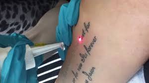 Roughly half of all men who get tattoos end up regretting them, according to a new tattoo survey. No Regrets Tattoo Removal Fine Script Removal Youtube