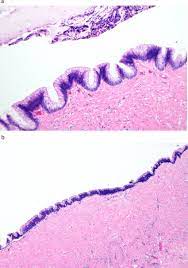 A Low Grade Appendiceal Mucinous Neoplasm Lamn High Power Field B Download Scientific Diagram