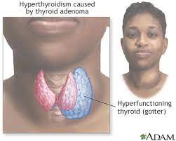 Thyroid problems are the first step in a vast host of other diseases. Hyperthyroidism Overactive Thyroid Symptoms And Causes