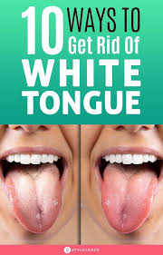10 Ways To Get Rid Of White Tongue And Make It Healthier In 2020 White Tongue Tongue Health Healthy Tongue
