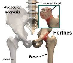 Treatment is typically observation in children less than 8 years of age, and femoral and/or pelvic. Perthes Disease Physio Works