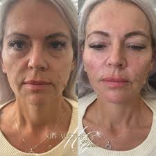 💋 Dissolve & Refill for the Perfect Pout 💉 Sometimes, the best results  come from starting fresh! ✨ We've dissolved the previous filler to create a  clean canvas, then carefully refilled with