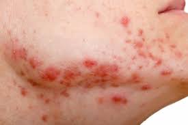 Check spelling or type a new query. 8 Tipos De Manchas De Pele Mais Comuns E Como Tirar Jawline Acne Acne Causes Treat Acne Naturally