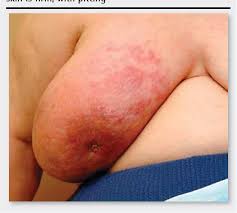 The distinction between true inflammatory breast cancer that forms and progresses rapidly. Pdf Approach To Inflammatory Breast Cancer Semantic Scholar