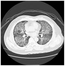 When the cartilage breaks down and wears away, the bones rub together. The Crazy Paving Pattern On Computed Tomography Cmaj