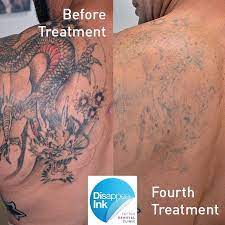 It is performed as a day surgery only. Sydney Laser Tattoo Removal