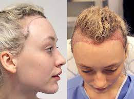 Women tend to shed all over their heads or around the parting, while bald patches at the forehead and temples are considered a male problem. This Woman Started Balding Because Of Her Too Tight Buns Self