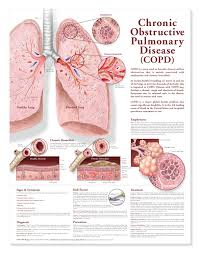 Chronic Obstructive Pulmonary Disease Copd Chart Poster