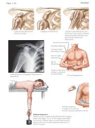 Anterior Dislocation Of Glenohumeral Joint About 95 Of Shoulder Dislocations Are Anterior And Are Chiefly Du Dislocation Shoulder Dislocation Shoulder Anatomy