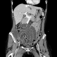 Image result for Radiation Colitis