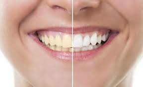 Coffee is great for your health and teeth if you drink in moderation. 7 Ways To Get Rid Of Yellow Teeth