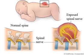 Spina Bifida Split Spine What Is It Myelomeningocele Spina Bifida Spina Bifida Awareness Month