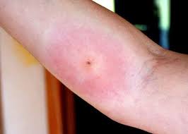 Image result for wolf spider bite skin