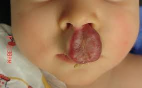 Being enerally harmless, they do not need treatment unless there is bleeding. New York Lip Hemangioma Treatment Before And After Photos