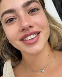 Perfect lip filler 👄 #מילוישפתיים #חומצההיאלורונית #הזרקות