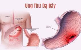 Dạ dày trung gian giữa dạ dày đơn và dạ dày kép như dạ dày của lợn. Há»— Trá»£ Ä'áº©y Lui Ä'au Dáº¡ Day Ä'Æ¡n Giáº£n Hiá»‡u Quáº£