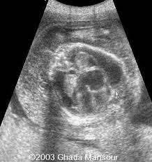 Image result for Rh Sensitization