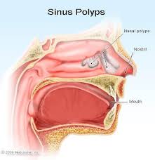 Larger growths or groups of nasal polyps can block nasal polyps themselves are soft and lack sensation, so if they're small, you may not be aware you. Definition Of Nasal Polyps