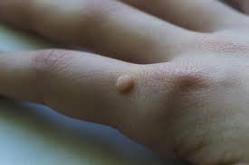 Daging tumbuh atau juga disebut skin tag adalah pertumbuhan daging di kulit dalam satu atau beberapa bagian tubuh, yang sering dikira tumor. Benjolan Di Jari Tangan Mengetahui Penyebab Dan Cara Mengatasinya
