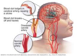 Plaques partially block the artery, and can rupture and bleed, forming a blood clot. Stroke Symptoms And Causes Mayo Clinic