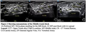 Image result for Superior Trunk Block