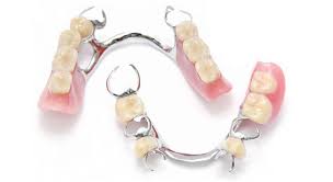 We did not find results for: Removable Partial Dentures Precision Attachments Cost And Metal Clasps