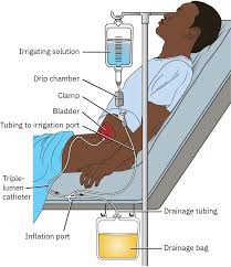 Image result for Continuous Bladder Irrigation